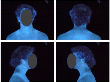 (4 images cropped together) Test subject demonstrates the absence of particulate buildup on the face and neck under a black light. 